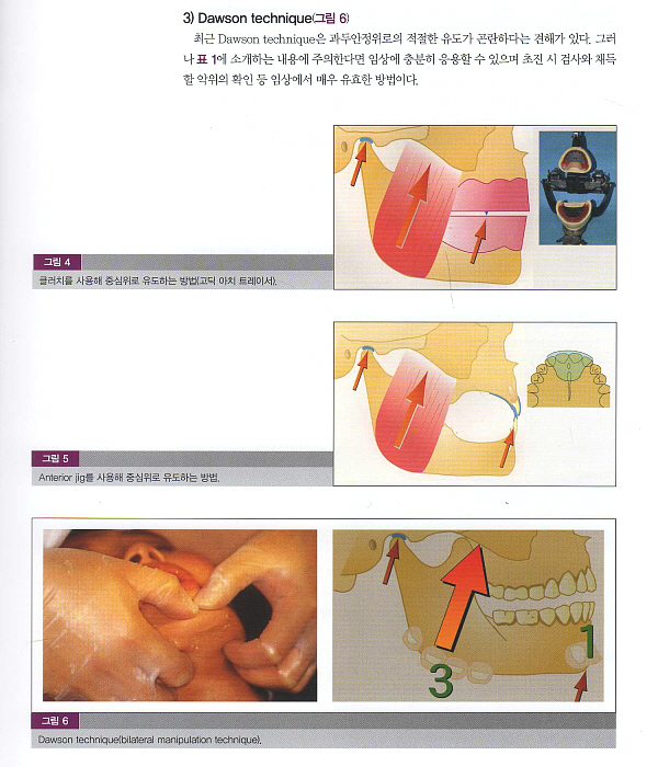 교합조정 테크닉 