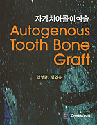 자가치아골이식술 - Autogenous Tooth Bone Graft -