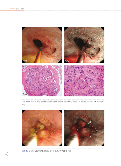 소화기 내시경 NBI Atlas