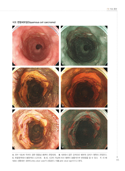 소화기 내시경 NBI Atlas