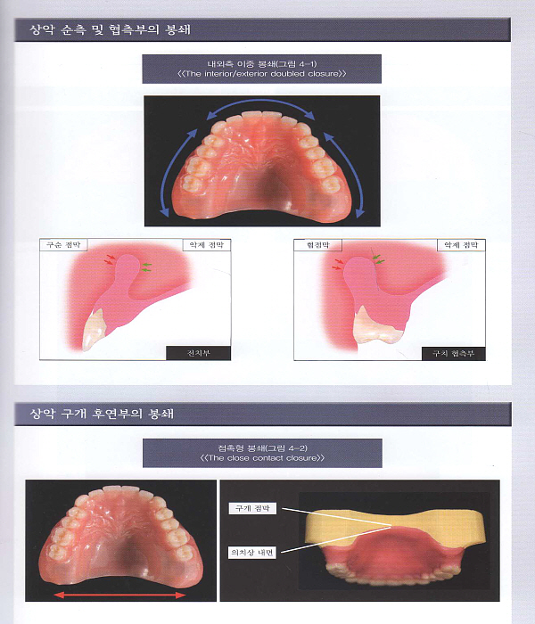 4-STEP로 완성 하악 흡착식 의치와 BPS Perfect Manual 