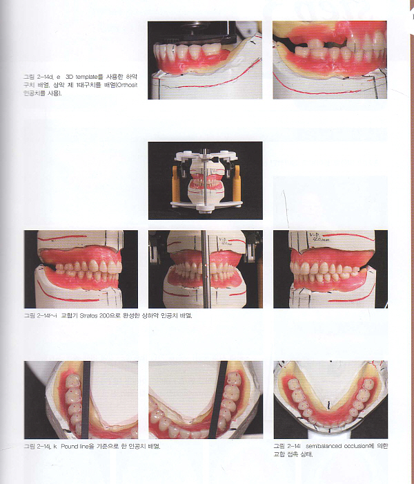 4-STEP로 완성 하악 흡착식 의치와 BPS Perfect Manual 