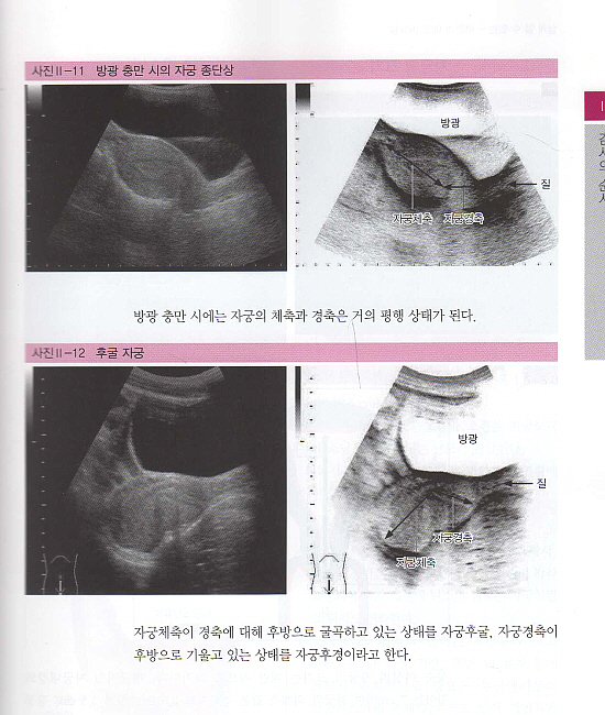 부인과초음파매뉴얼-쉽게알수있는:체외식 초음파로 보는 질환 검사 요령