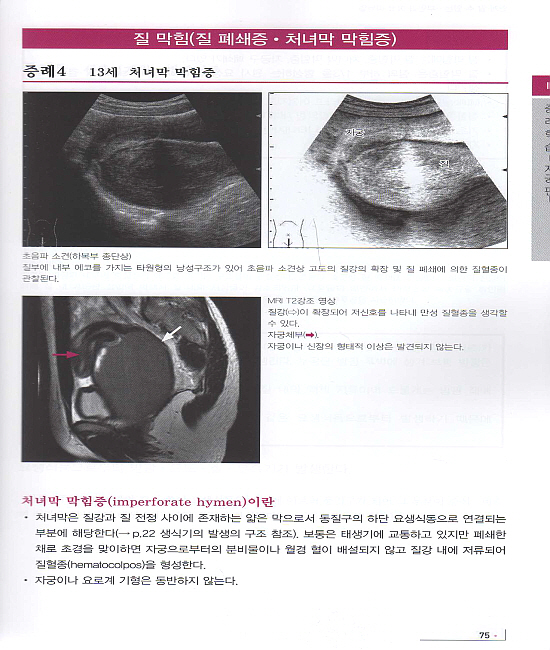 부인과초음파매뉴얼-쉽게알수있는:체외식 초음파로 보는 질환 검사 요령