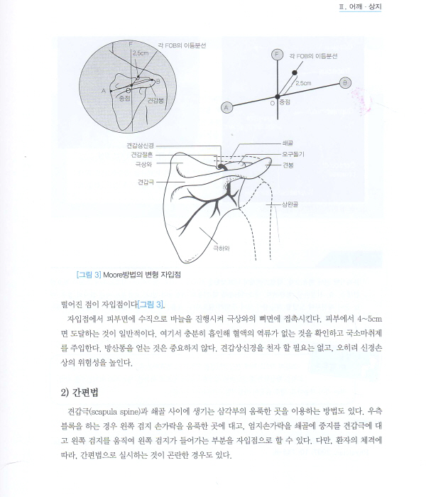 알기쉬운 신경블록법