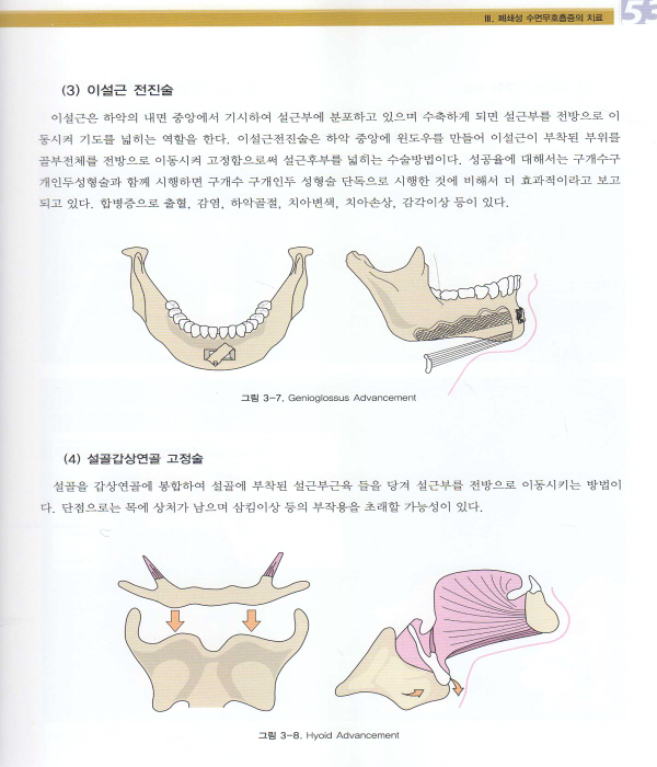 코골이 및 수면무호흡증의 구강장치 치료(Oral Appliance Therapy for Snoring & OSA)