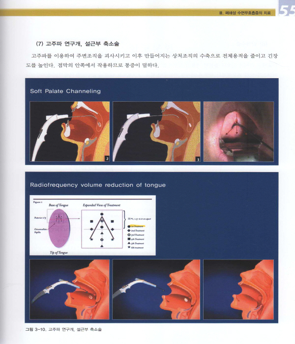 코골이 및 수면무호흡증의 구강장치 치료(Oral Appliance Therapy for Snoring & OSA)