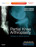 Partial Knee Arthroplasty