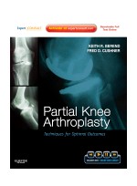 Partial Knee Arthroplasty