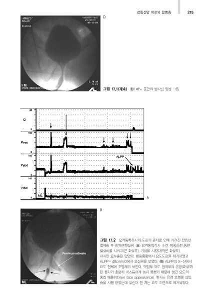 요역동학검사 아틀라스, (Urodynamics,UDS)