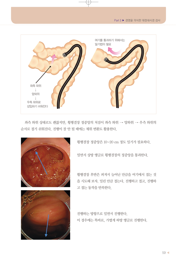 무통대장내시경 삽입법 - 공기를 넣지 않는