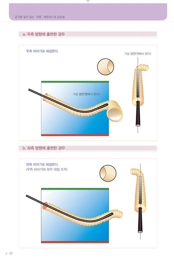 무통대장내시경 삽입법 - 공기를 넣지 않는