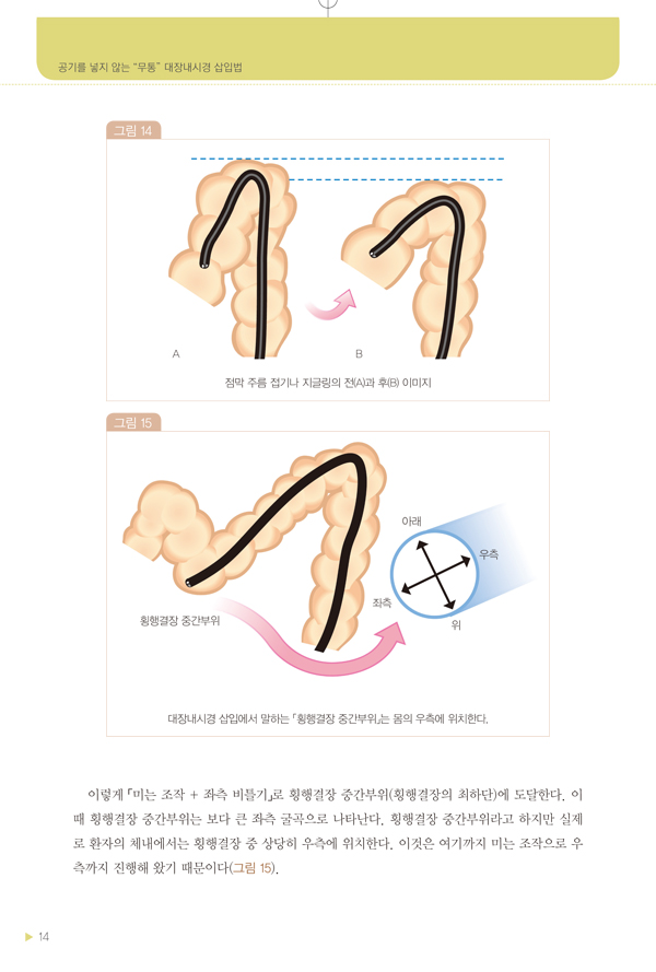 무통대장내시경 삽입법 - 공기를 넣지 않는