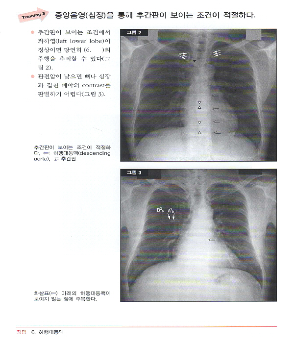 단계별로 이해하는 흉부 X선 영상진단 ABC [양장본] 